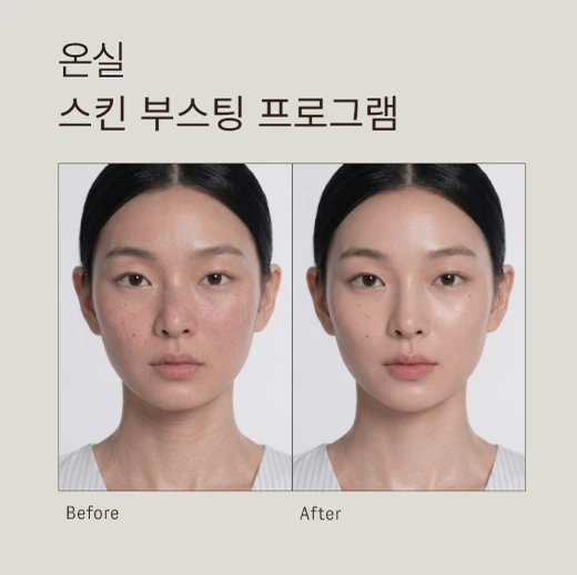 온실 복합 초음파 리프팅 ㅣ 울쎄라 + 튠라이너